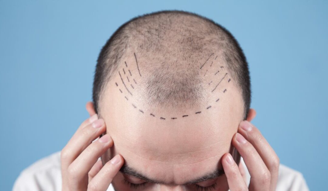Quelles sont les étapes de la greffe de cheveux FUT ?
