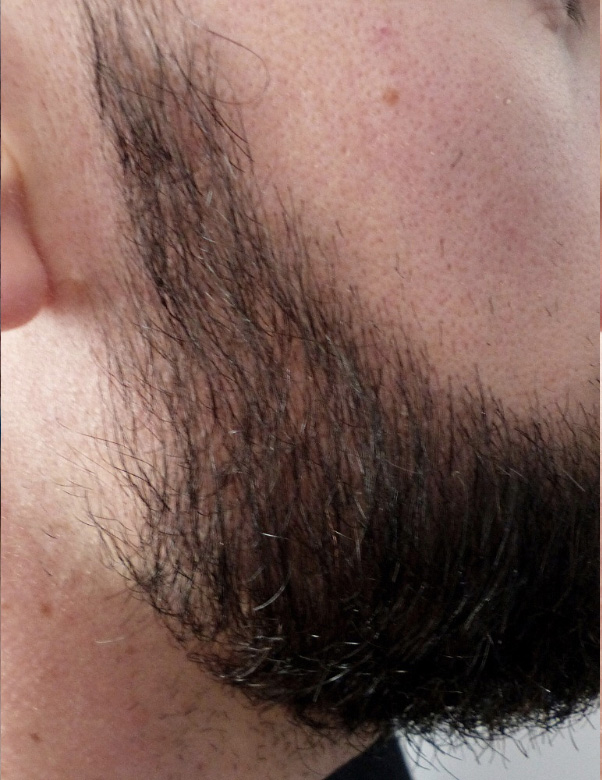 02-greffe-barbe-turquie-apres