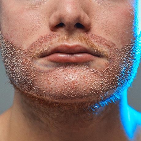 greffe implant barbe homme clinique turquie prix